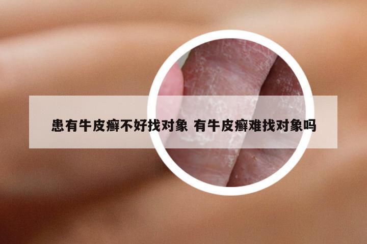 患有牛皮癣不好找对象 有牛皮癣难找对象吗