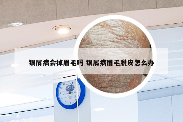 银屑病会掉眉毛吗 银屑病眉毛脱皮怎么办