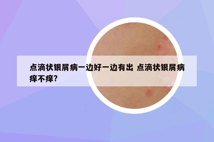 点滴状银屑病一边好一边有出 点滴状银屑病痒不痒?