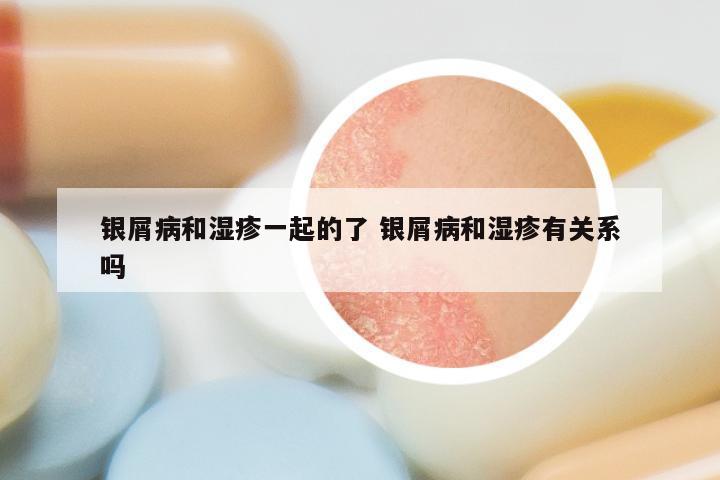 银屑病和湿疹一起的了 银屑病和湿疹有关系吗