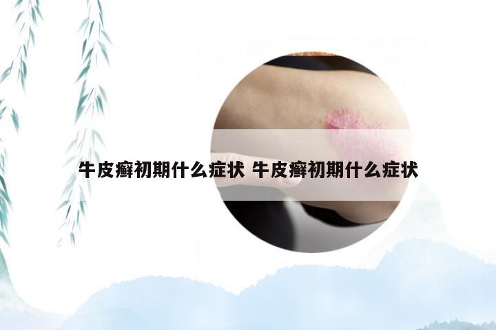 牛皮癣初期什么症状 牛皮癣初期什么症状