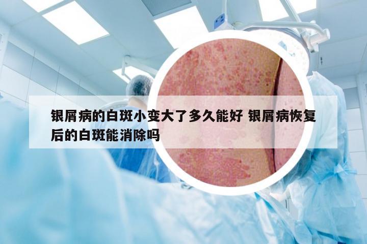 银屑病的白斑小变大了多久能好 银屑病恢复后的白斑能消除吗