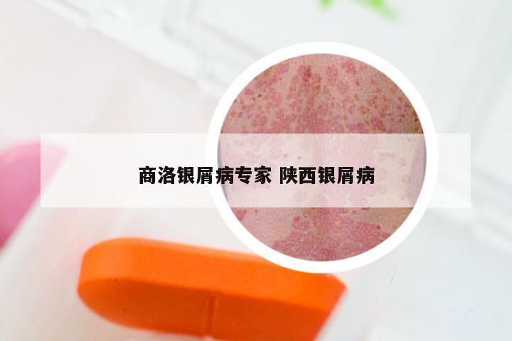 商洛银屑病专家 陕西银屑病