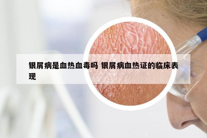 银屑病是血热血毒吗 银屑病血热证的临床表现