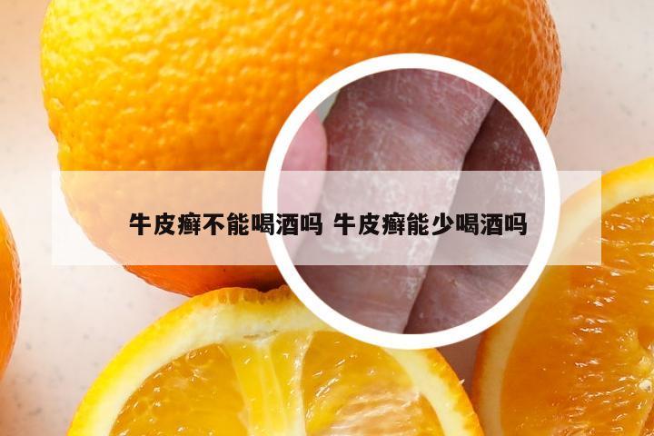 牛皮癣不能喝酒吗 牛皮癣能少喝酒吗