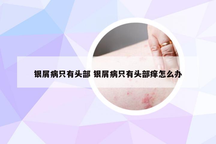 银屑病只有头部 银屑病只有头部痒怎么办