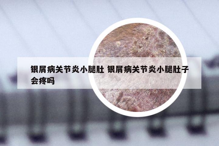 银屑病关节炎小腿肚 银屑病关节炎小腿肚子会疼吗