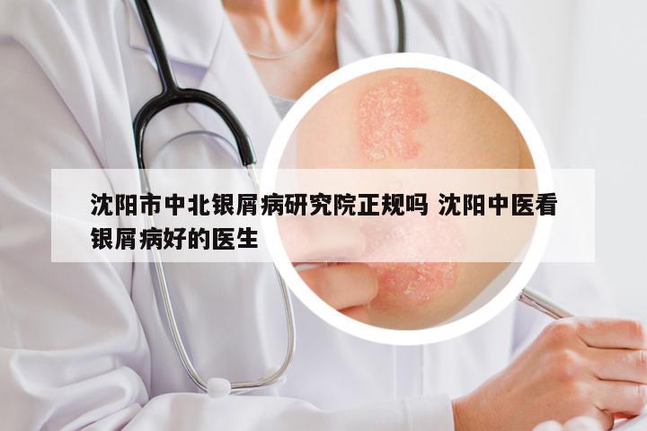 沈阳市中北银屑病研究院正规吗 沈阳中医看银屑病好的医生