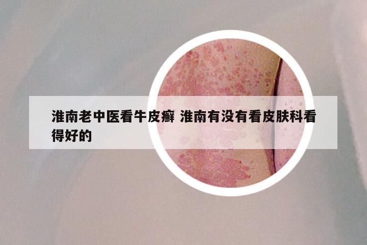 淮南老中医看牛皮癣 淮南有没有看皮肤科看得好的