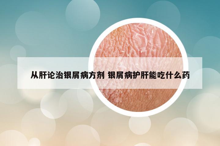 从肝论治银屑病方剂 银屑病护肝能吃什么药