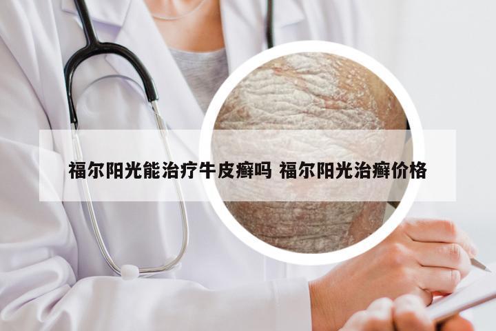福尔阳光能治疗牛皮癣吗 福尔阳光治癣价格