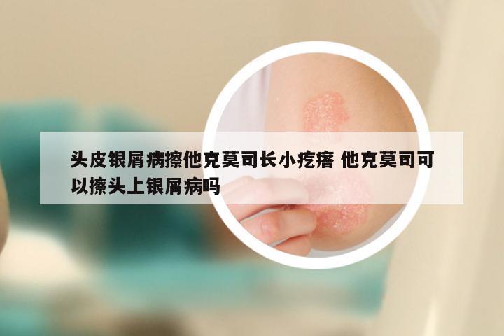 头皮银屑病擦他克莫司长小疙瘩 他克莫司可以擦头上银屑病吗