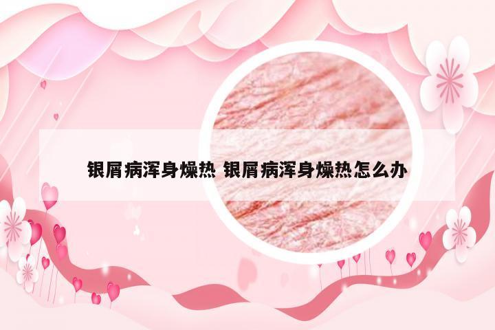 银屑病浑身燥热 银屑病浑身燥热怎么办