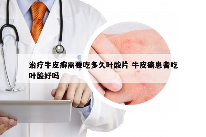 治疗牛皮癣需要吃多久叶酸片 牛皮癣患者吃叶酸好吗