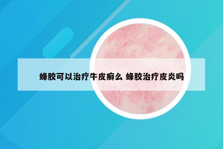 蜂胶可以治疗牛皮癣么 蜂胶治疗皮炎吗