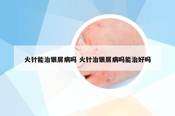 火针能治银屑病吗 火针治银屑病吗能治好吗