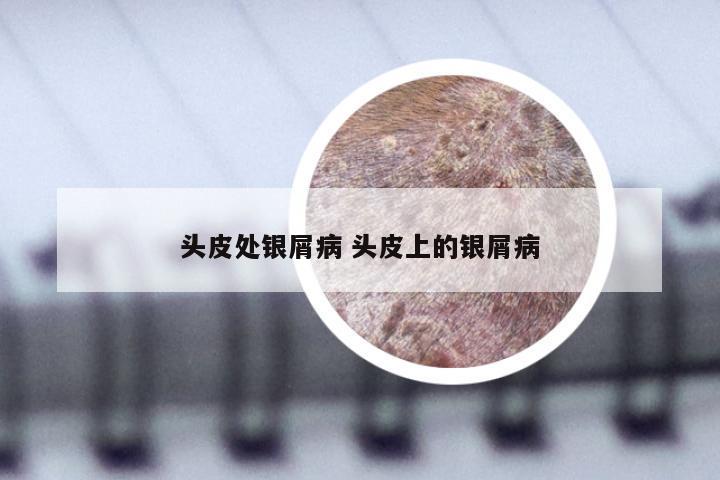 头皮处银屑病 头皮上的银屑病