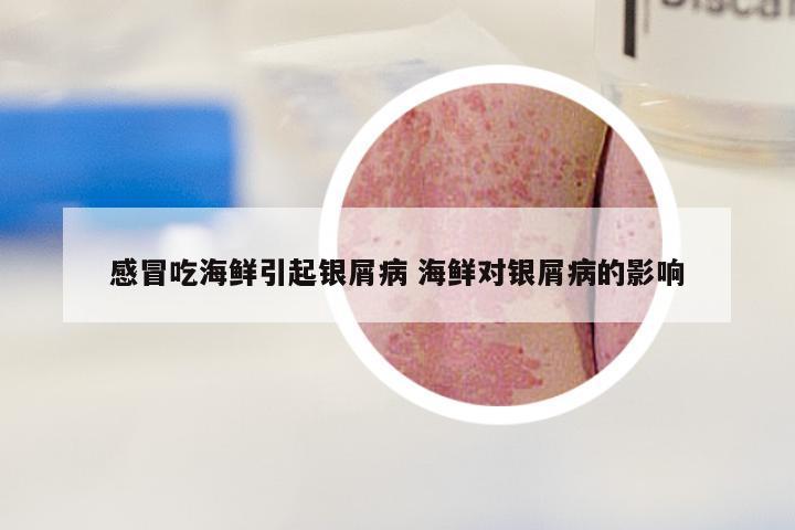 感冒吃海鲜引起银屑病 海鲜对银屑病的影响
