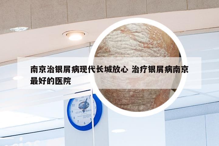南京治银屑病现代长城放心 治疗银屑病南京最好的医院