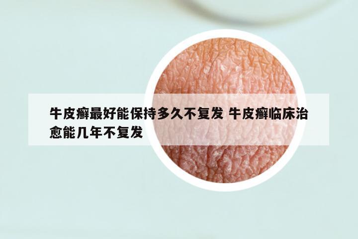 牛皮癣最好能保持多久不复发 牛皮癣临床治愈能几年不复发