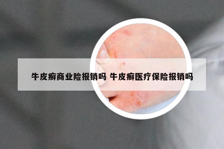 牛皮癣商业险报销吗 牛皮癣医疗保险报销吗