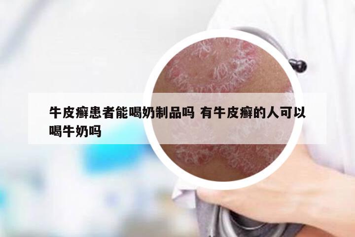 牛皮癣患者能喝奶制品吗 有牛皮癣的人可以喝牛奶吗