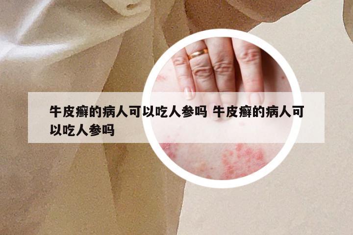 牛皮癣的病人可以吃人参吗 牛皮癣的病人可以吃人参吗