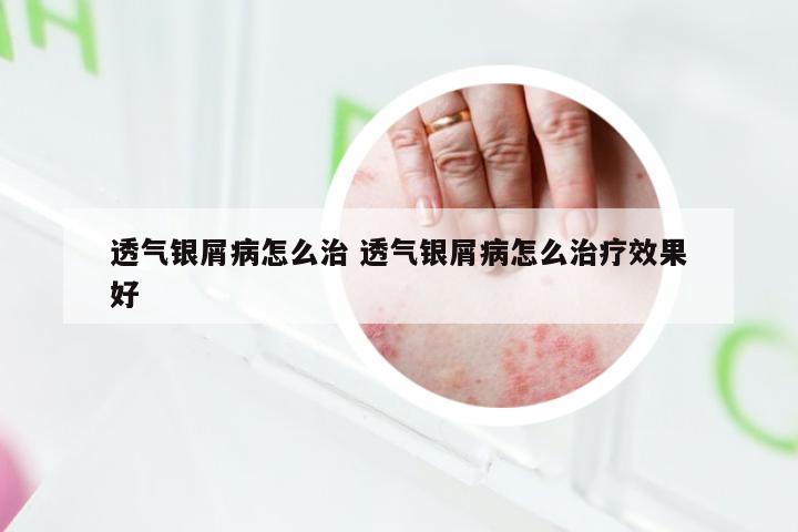 透气银屑病怎么治 透气银屑病怎么治疗效果好