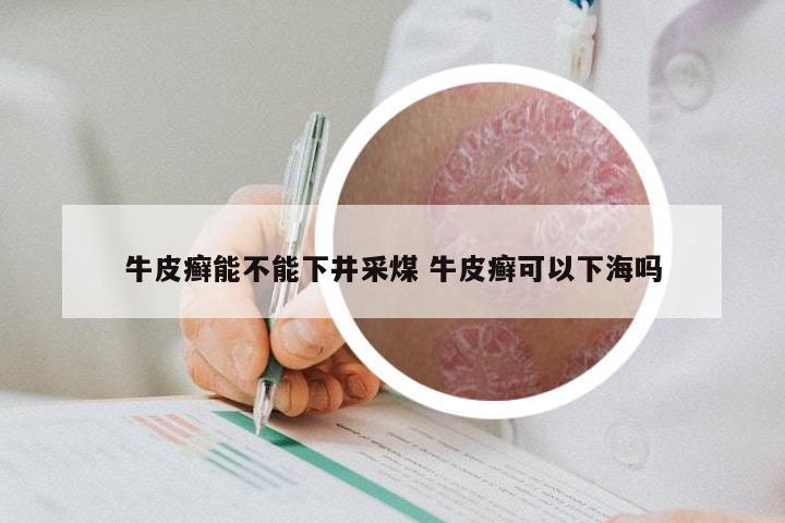 牛皮癣能不能下井采煤 牛皮癣可以下海吗