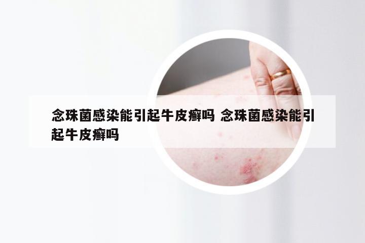 念珠菌感染能引起牛皮癣吗 念珠菌感染能引起牛皮癣吗