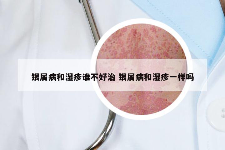 银屑病和湿疹谁不好治 银屑病和湿疹一样吗