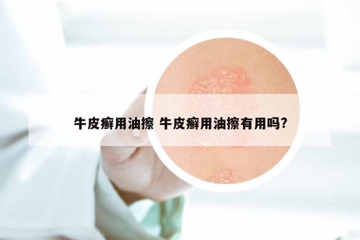 牛皮癣用油擦 牛皮癣用油擦有用吗?
