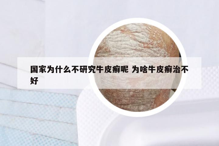 国家为什么不研究牛皮癣呢 为啥牛皮癣治不好
