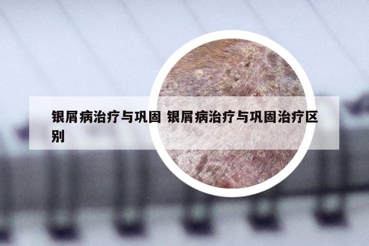 银屑病治疗与巩固 银屑病治疗与巩固治疗区别
