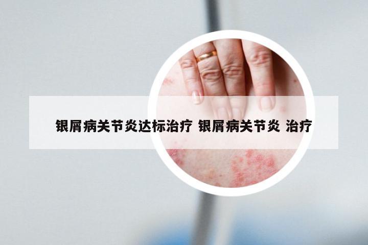 银屑病关节炎达标治疗 银屑病关节炎 治疗