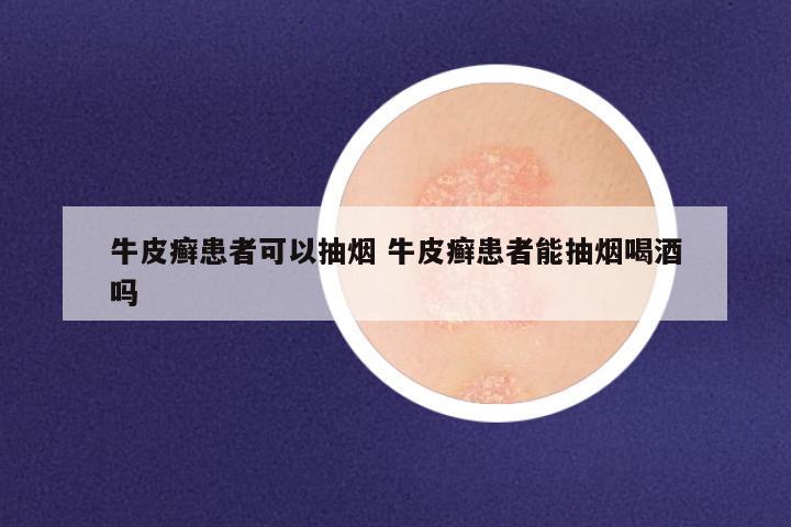 牛皮癣患者可以抽烟 牛皮癣患者能抽烟喝酒吗