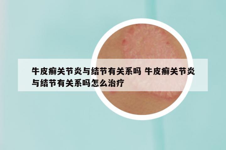 牛皮癣关节炎与结节有关系吗 牛皮癣关节炎与结节有关系吗怎么治疗