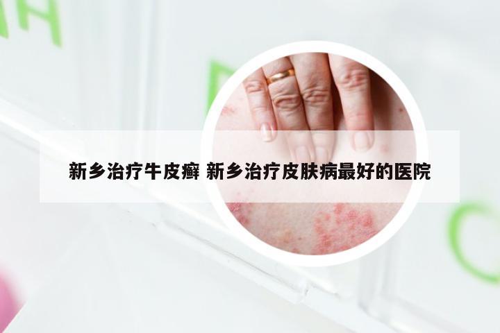 新乡治疗牛皮癣 新乡治疗皮肤病最好的医院