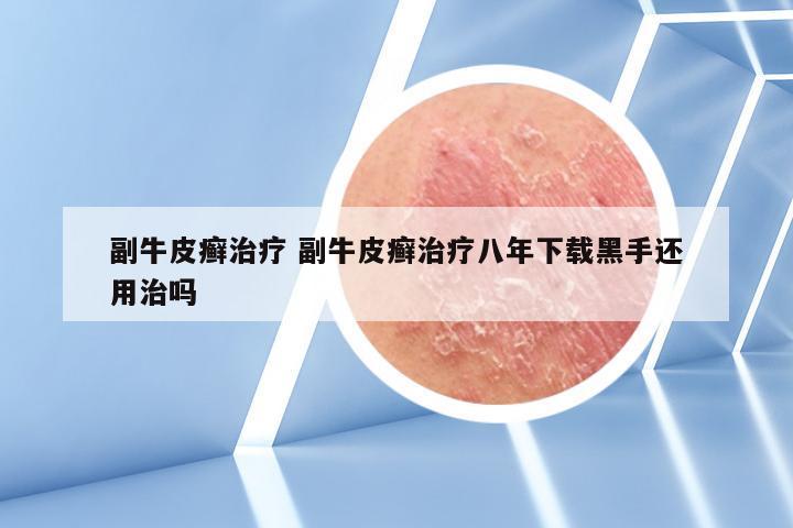 副牛皮癣治疗 副牛皮癣治疗八年下载黑手还用治吗