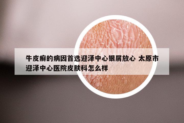 牛皮癣的病因首选迎泽中心银屑放心 太原市迎泽中心医院皮肤科怎么样