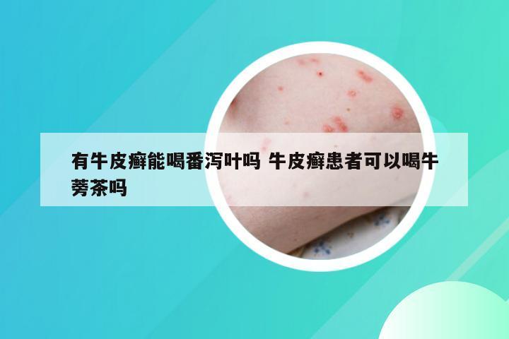 有牛皮癣能喝番泻叶吗 牛皮癣患者可以喝牛蒡茶吗