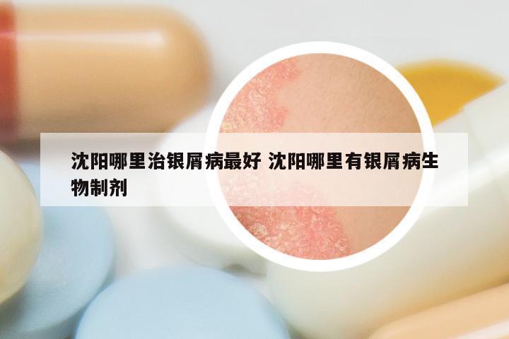 沈阳哪里治银屑病最好 沈阳哪里有银屑病生物制剂