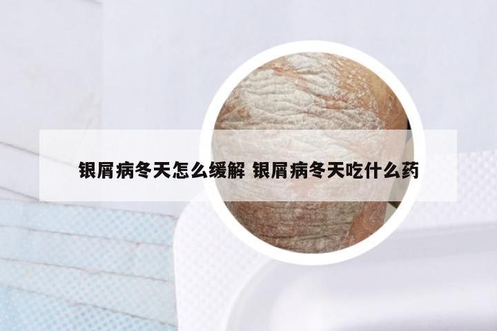 银屑病冬天怎么缓解 银屑病冬天吃什么药