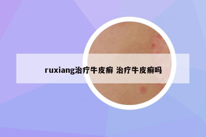 ruxiang治疗牛皮癣 治疗牛皮癣吗
