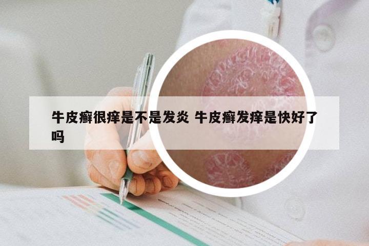 牛皮癣很痒是不是发炎 牛皮癣发痒是快好了吗