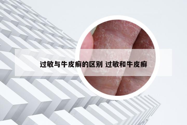 过敏与牛皮癣的区别 过敏和牛皮癣