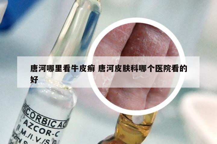 唐河哪里看牛皮癣 唐河皮肤科哪个医院看的好