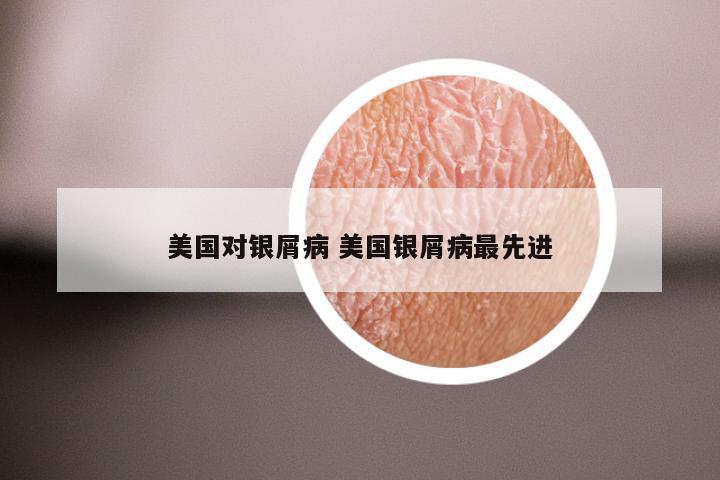 美国对银屑病 美国银屑病最先进