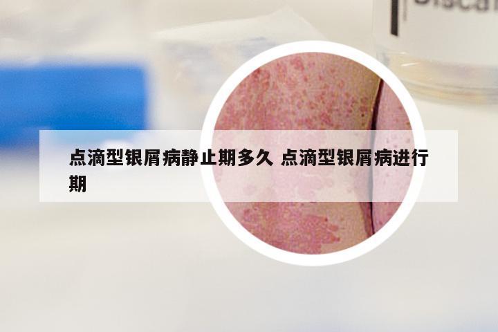 点滴型银屑病静止期多久 点滴型银屑病进行期