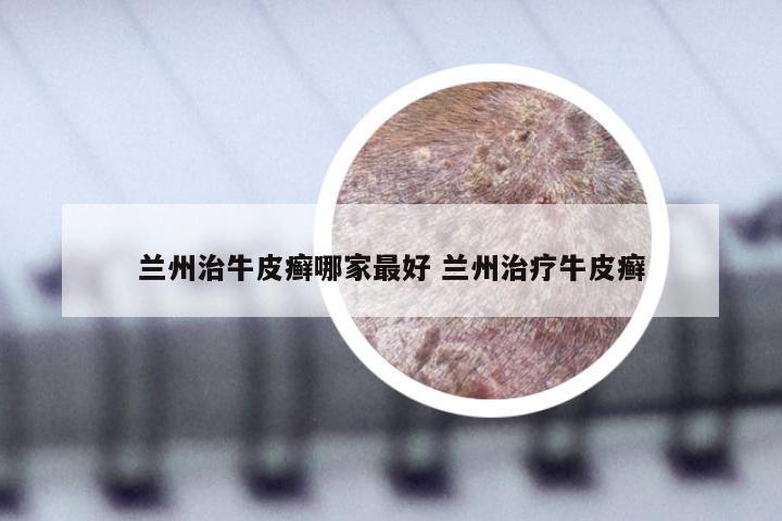 兰州治牛皮癣哪家最好 兰州治疗牛皮癣